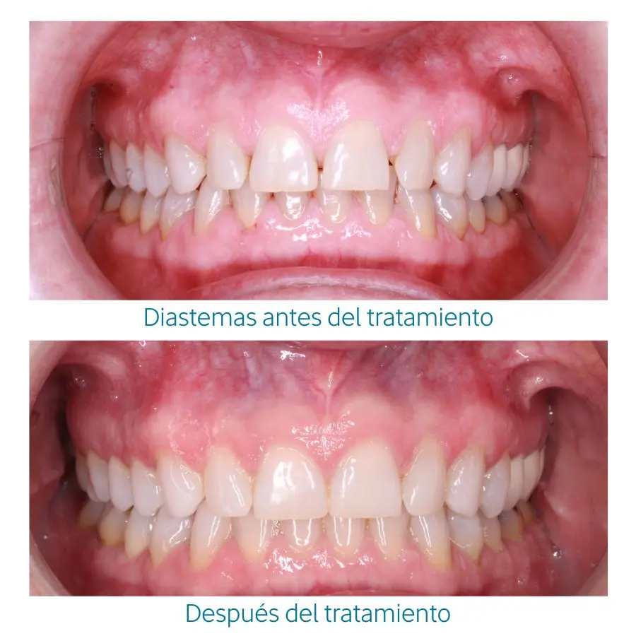 Tratamiento de diastemas con ortodoncia invisible
